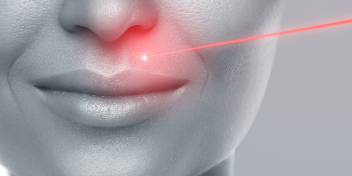 laserska epilacija na licu