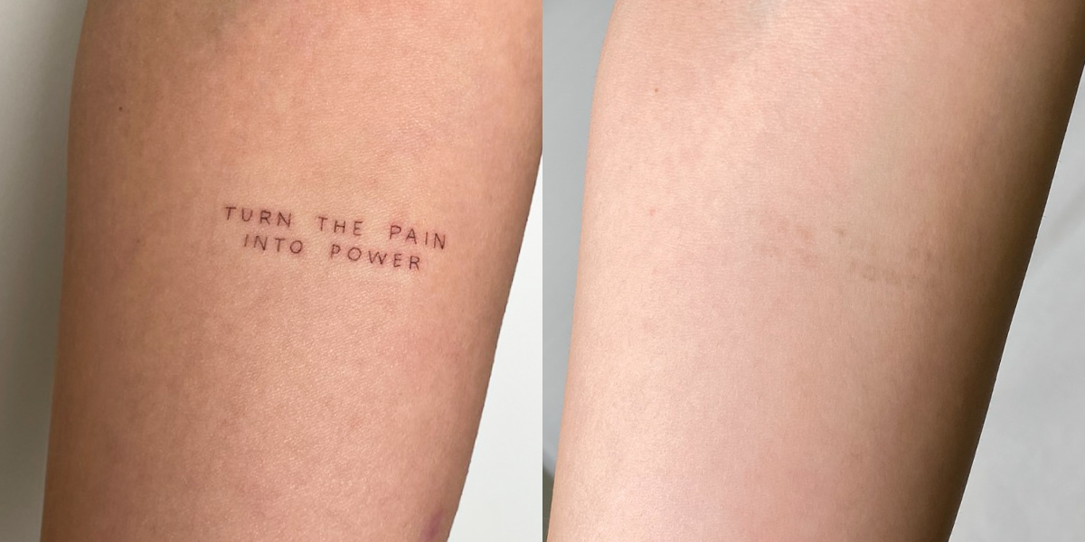 lasersko uklanjanje tetovaza rea medika