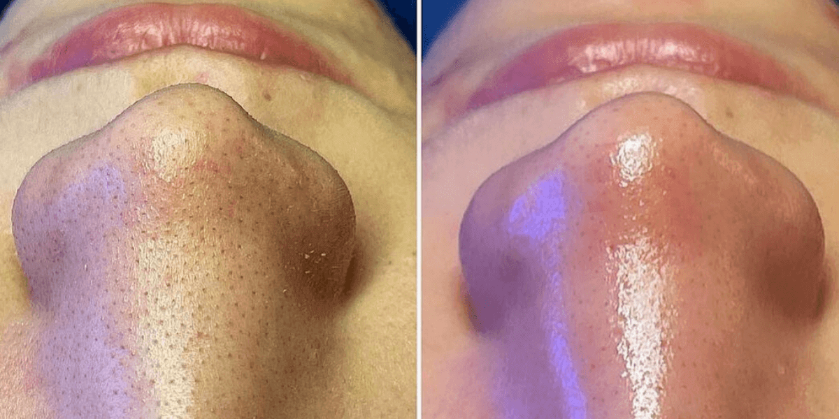 hydraFacial Platinum процедура