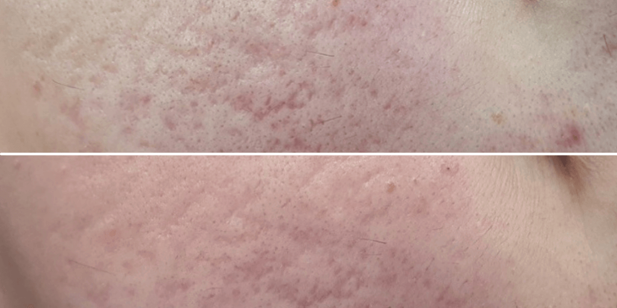 пептидная мезотерапия с применением аппарата Dermafix