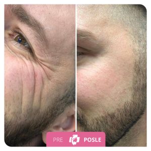 Botulinum Toxin 