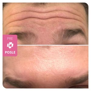 Botulinum Toxin 
