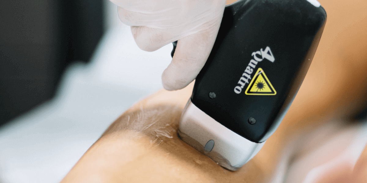 Laser hair removal 