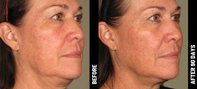 Ultherapy  results