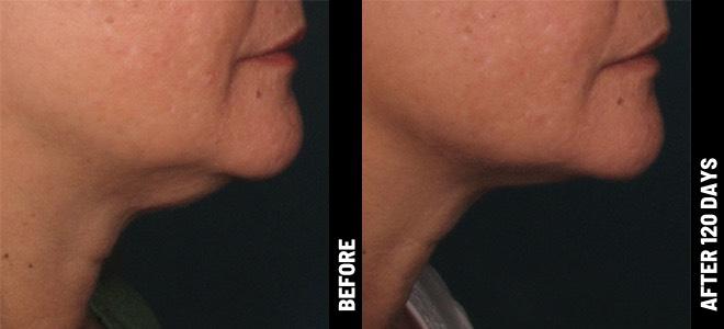 Ultherapy before after