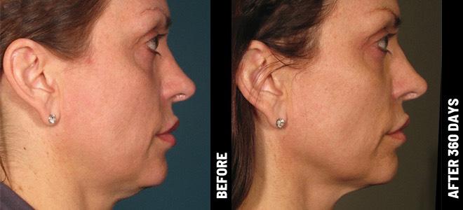 Ultherapy rejuvenation