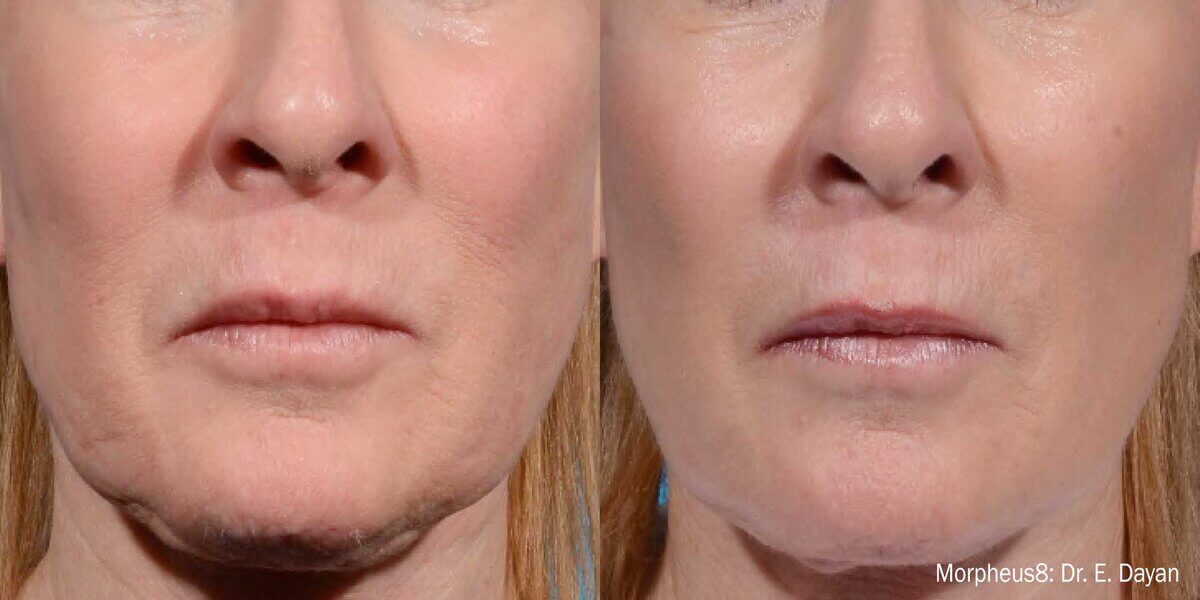 Morpheus 8 treatment